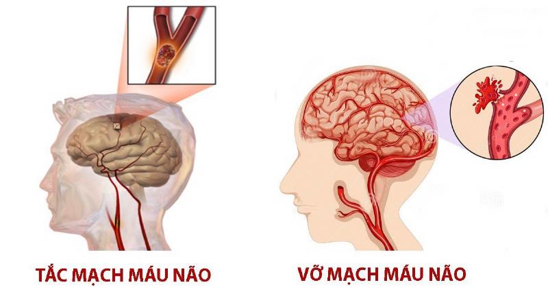 Hình ảnh minh họa về đột quỵ não