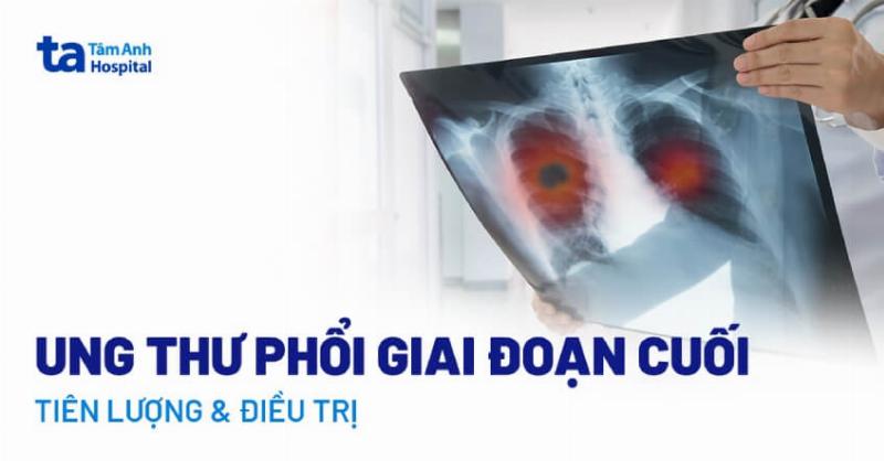 anh-minh-hoa-ung-thu-phoi-giai-doan-cuoi