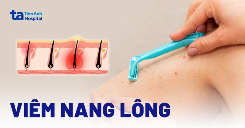 Cac tac nhan chinh khien da tay bi viem nang long, vi khuan, nam