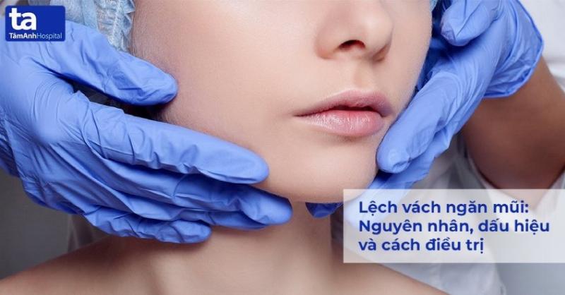 Hình ảnh minh họa phẫu thuật vẹo vách ngăn mũi