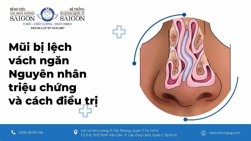 Hình ảnh minh họa vẹo vách ngăn mũi